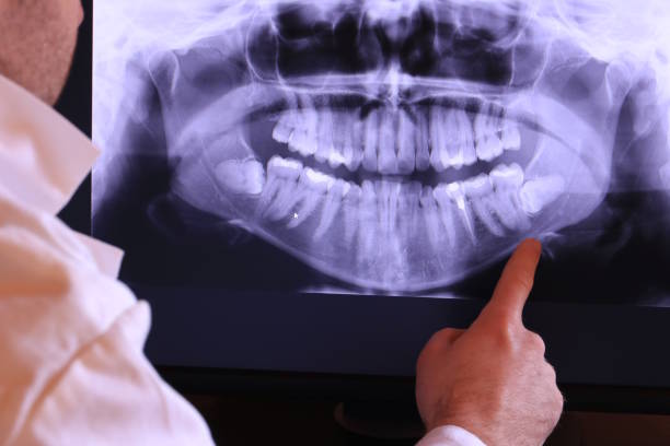 Best Emergency Tooth Extraction in Dobson, NC
